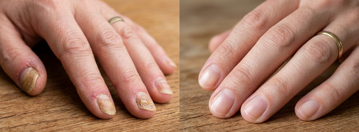 INFORMACJE DERMATOLOGICZNE